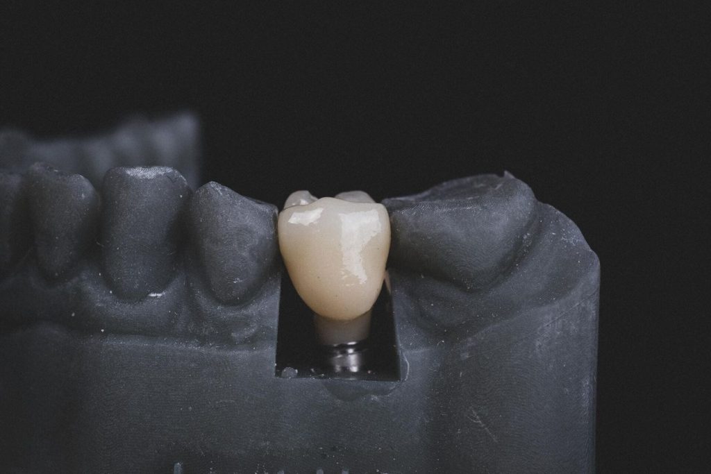 Quanto costa un impianto dentale: variabili da considerare 1 Quanto dura un impianto dentale a Prato - QUANTO COSTA UN IMPIANTO DENTALE