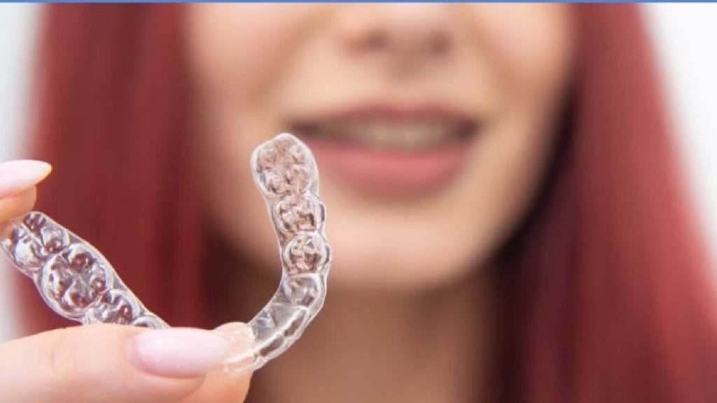 Apparecchi dentali trasparenti: scopriamo assieme il trattamento! 5 Apparecchio trasparente