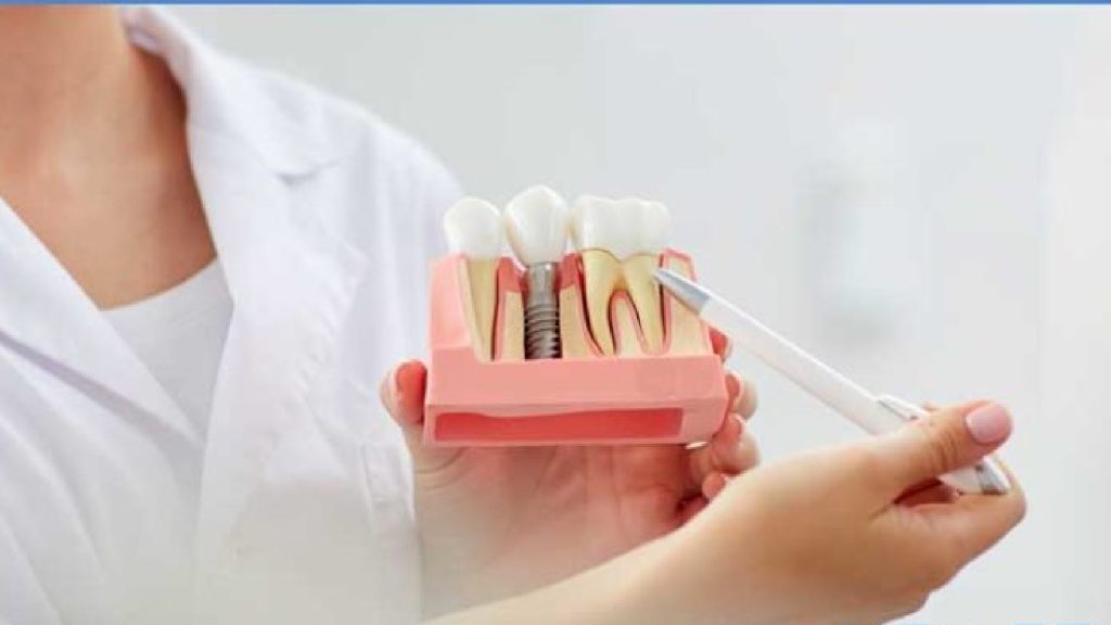 Quanto dura un impianto dentale