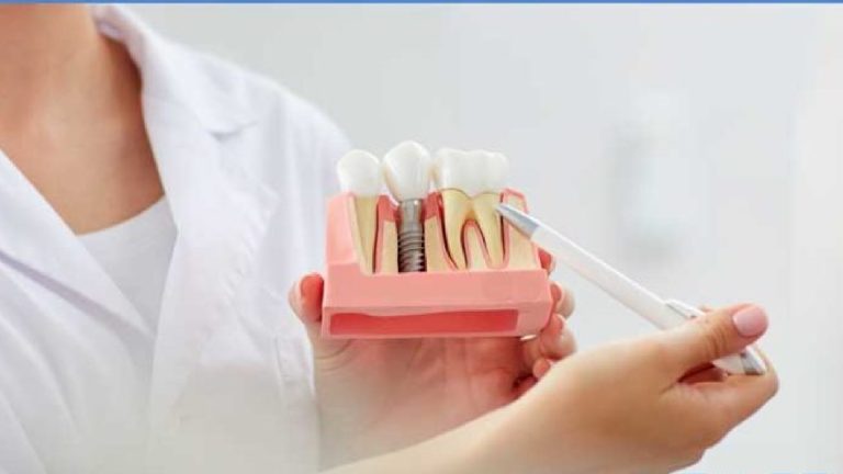 Blog 6 Quanto dura un impianto dentale
